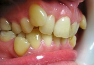 зубы расположены во рту слишком близко