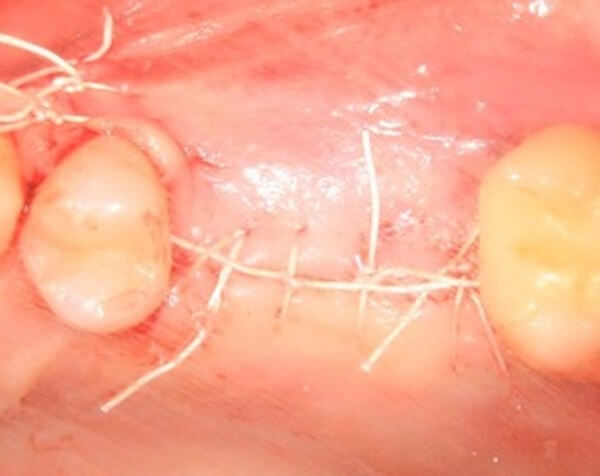 Чем чревато расхождение швов после имплантации зубов