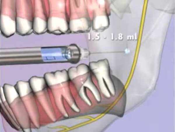 Техника проведения анестезии на нижней челюсти