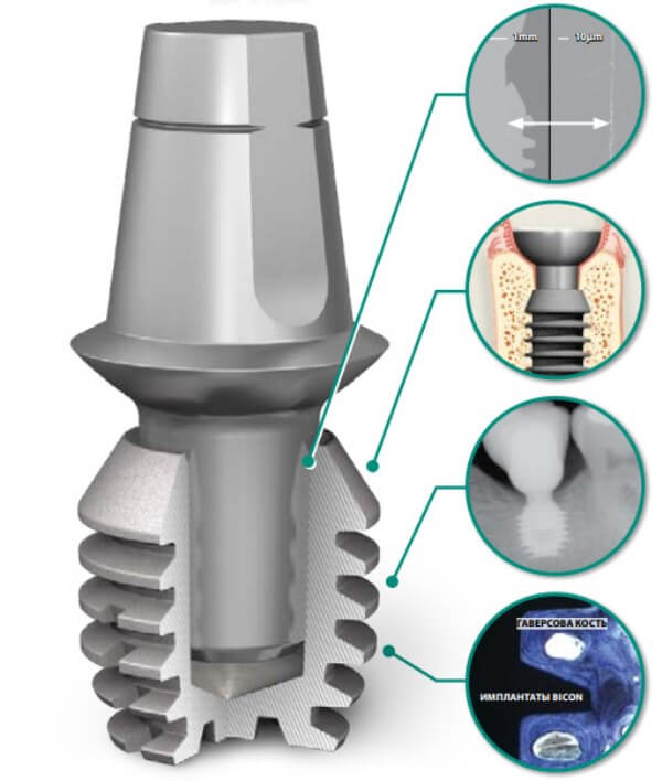 Как обеспечивается надежность имплантов Bicon