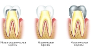 Какие коронки на зубы лучше