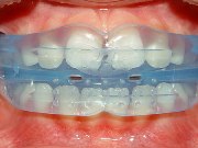 Действие ортодонтических трейнеров для зубов