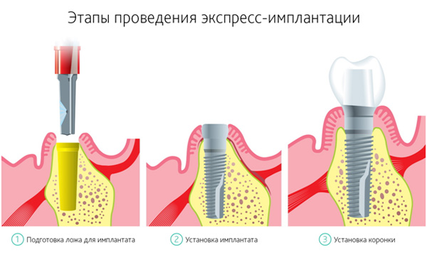 Экспресс имплантация зубов цены