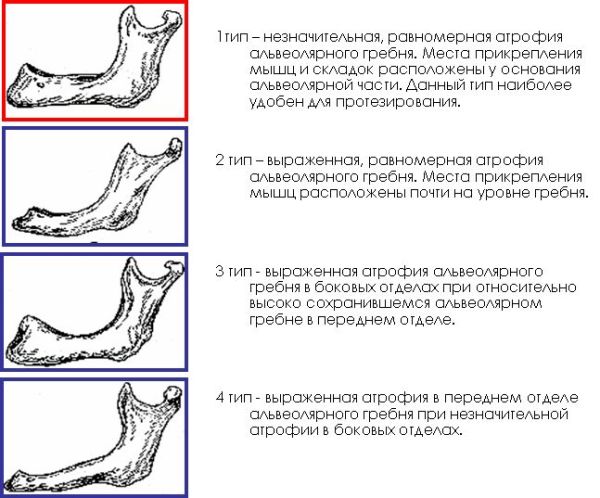 Классификация беззубых челюстей по курляндскому