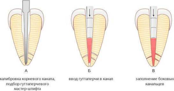 Состав гуттаперчевых штифтов в стоматологии фото