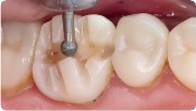 Особенности препарирования опорных зубов