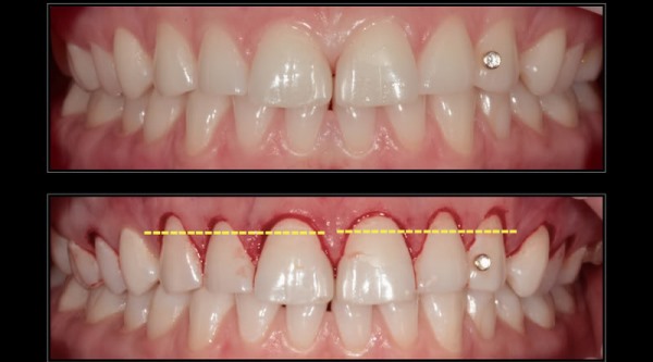 Виды зубосохраняющих операций