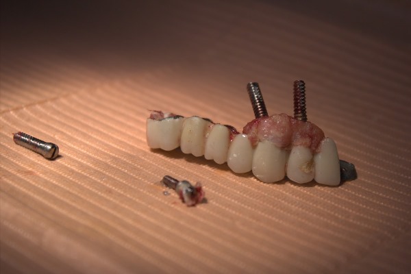 Профилактика отторжения зубного импланта