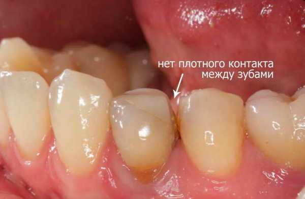 Неприятный запах из под коронки зуба причины