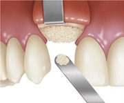 Вертикальная и горизонтальная аугментация альвеолярного гребня