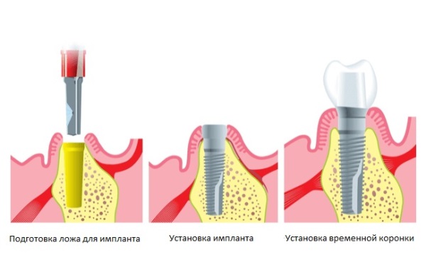 Риски при одноэтапной методике