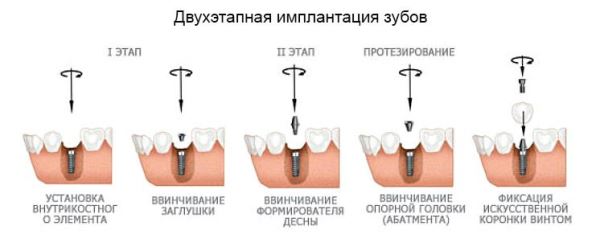 Двухэтапная методика