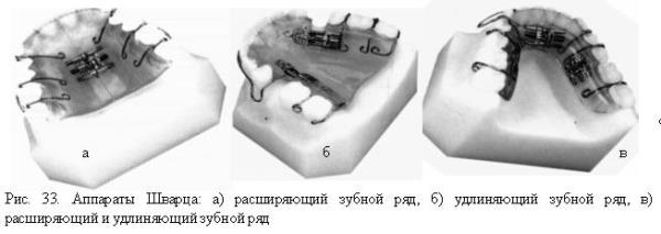 Аппарат шварца ортодонтия