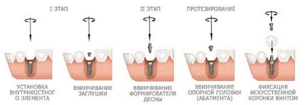 Имплантация 7 нижнего зуба