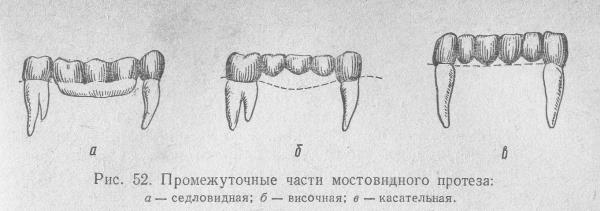 Цельнолитые мостовидные протезы с пластмассовой облицовкой