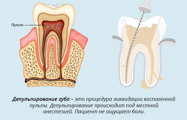 Депульпация зуба перед протезированием это