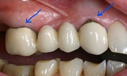 Показания к замене зубных коронок