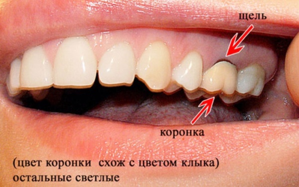 Как лечить кисту зуба под коронкой