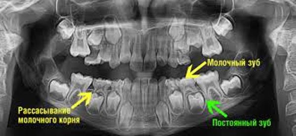 Резорбция корней временных зубов