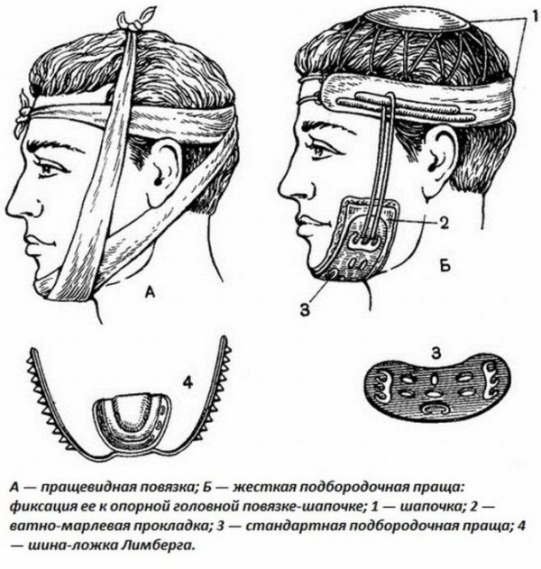 Пращевидная повязка на челюсть