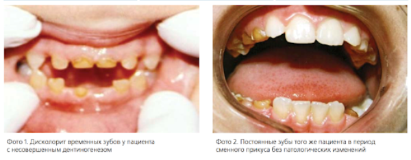 При несовершенном дентиногенезе синдром стейнтона капдепона поражены