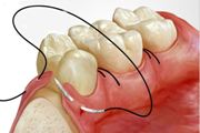 Стоматологические шовные материалы