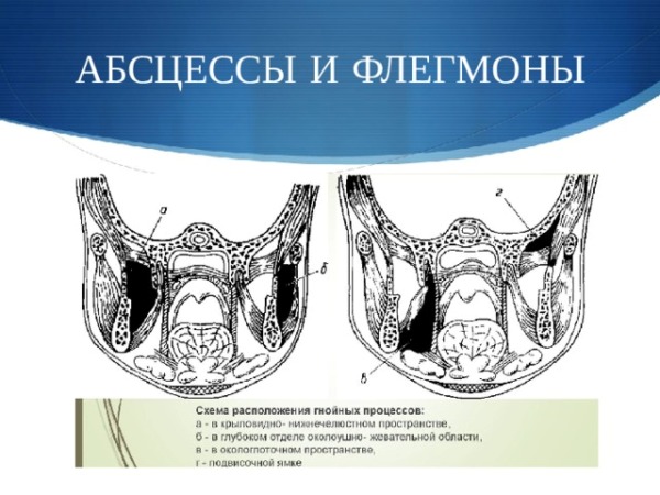 Абсцесс полости рта код +по мкб 10