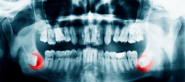 растет зуб мудрости какие у человека симптомы