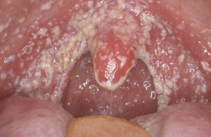 Как обезболить стоматит во рту в домашних условиях thumbnail