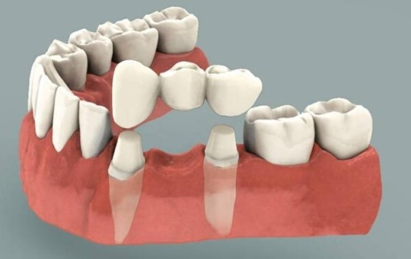 разновидности зубных мостов
