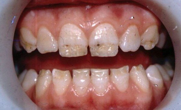 как выглядит гипоплазия эмали зубов