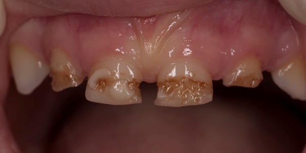 разновидности гипоплазии эмали зубов