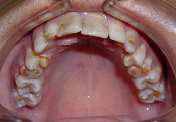 Гипоплазия зубов у ребенка 1 года thumbnail
