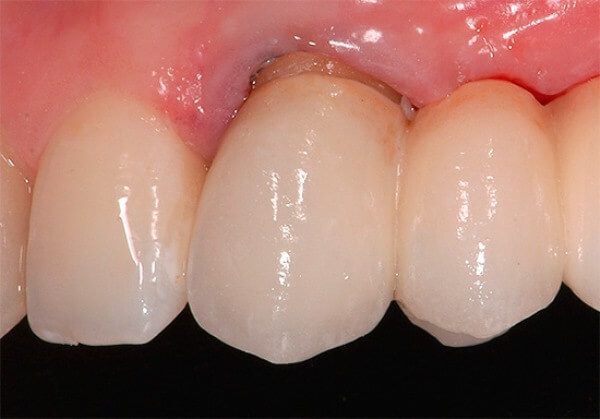 Особенности зубной боли при периодонтите
