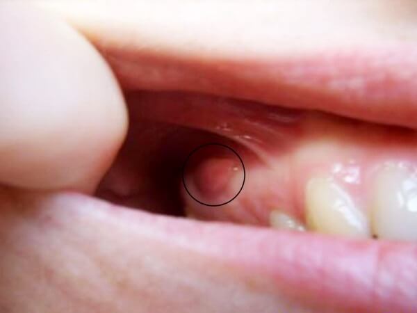 После лечения при нажатии на зуб боль что это может быть thumbnail