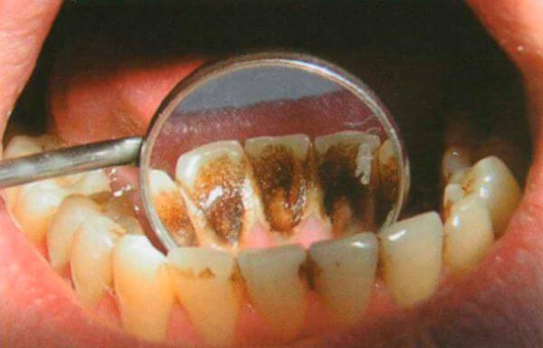 Лечение кислотного некроза зубов thumbnail