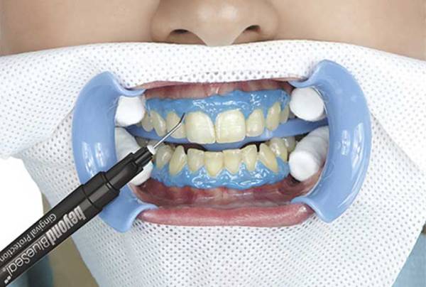 Защита зубов при лечении thumbnail