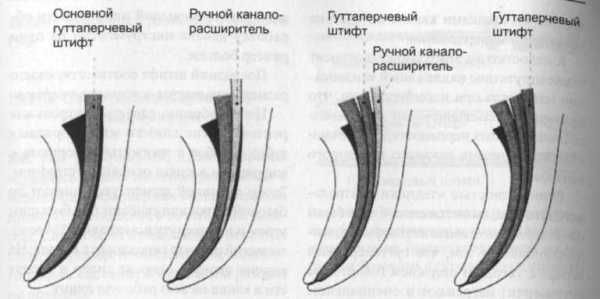 Пломбирование корневых каналов методом латеральной конденсации