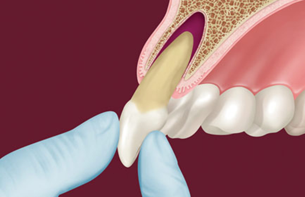 Лечение травм зубов у взрослых
