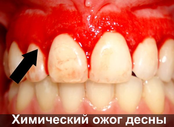 Ожог десны после лечения зуба thumbnail