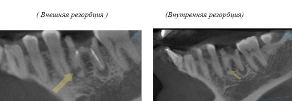 Резорбция это. Наружная резорбция корня зуба. Наружная цервикальная резорбция зуба. Патологическая резорбция корня наружная. Патологическая резорбция корня молочного зуба.